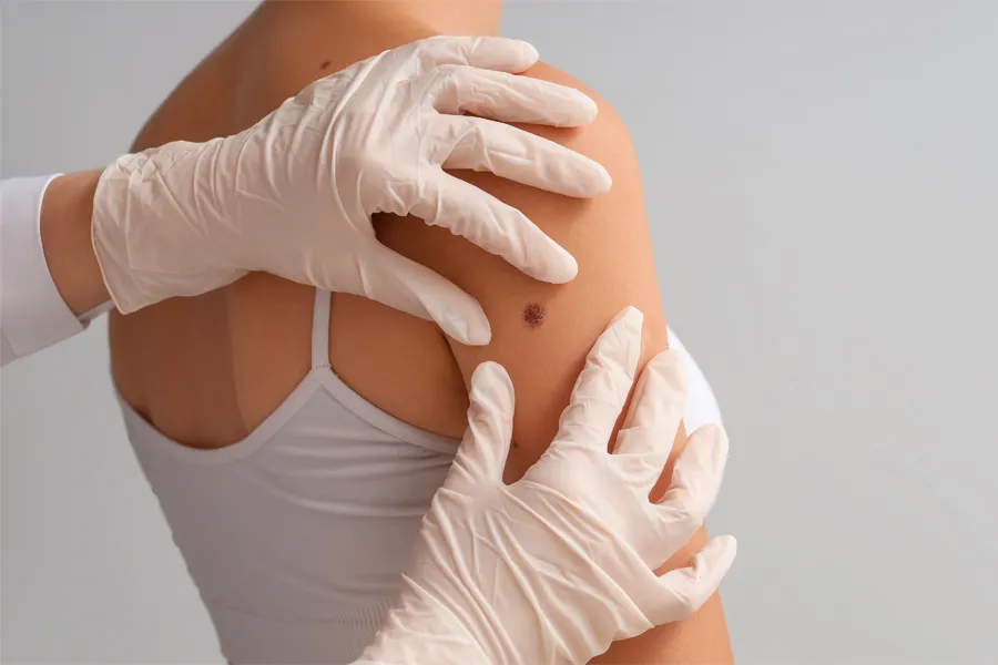 A clinician examines moles on a woman's shoulder. Get benign lesion removal from Yashoda Singh, MD in Hamilton-Toronto-Niagara.
