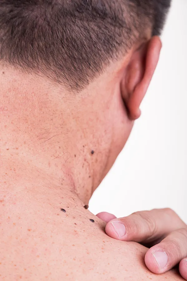 A man touches moles on his neck. Get benign lesion removal from Yashoda Singh, MD in Hamilton-Toronto-Niagara.