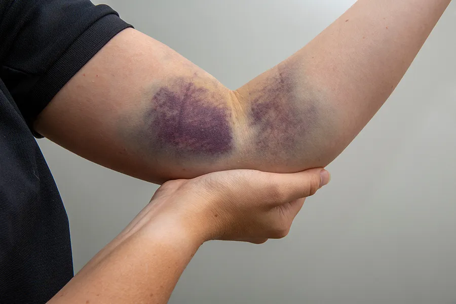 A person shows a bruise on their arm. Get bruise resolution treatment from Yashoda Singh, MD in Hamilton-Toronto-Niagara.