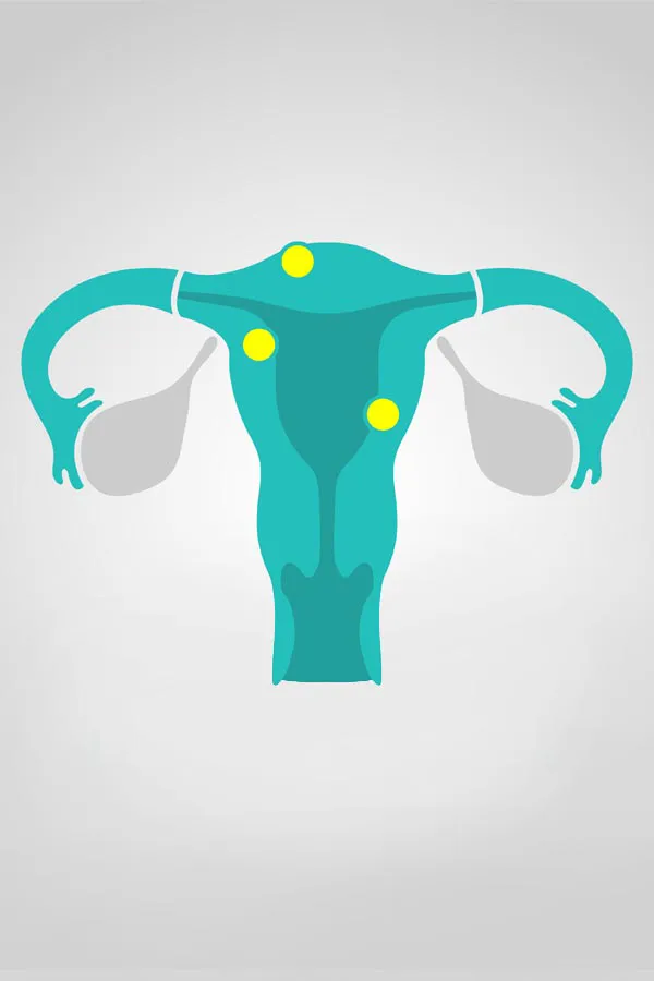 Illustration of a uterus with yellow dots indicating fibroids. Get treatment for fibroids from Yashoda Singh, MD in Hamilton-Toronto-Niagara.