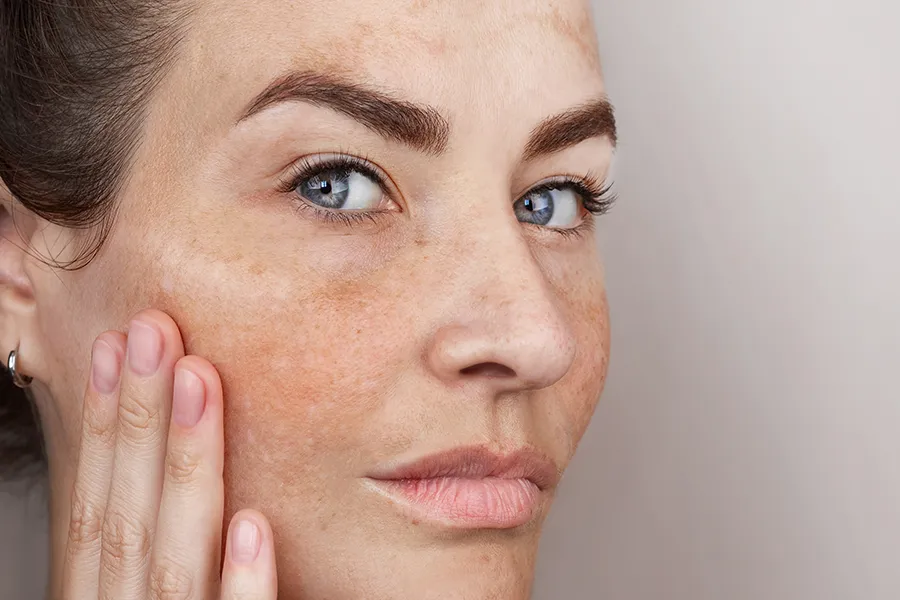 A woman with signs of melasma. Get green toning treatment for patchy skin from Yashoda Singh, MD in Hamilton-Toronto-Niagara.