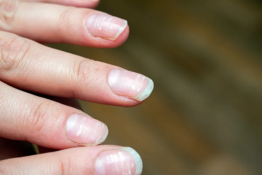 Close-up of a hand with nail fungus. Get nail fungus treatment from Yashoda Singh, MD in Hamilton-Toronto-Niagara.