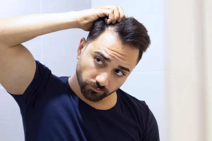 A man in a navy t-shirt looks in the mirror worrying about and touching his receding hairline, considering PRP for hair loss and restoration treatment from Yashoda Singh, MD in Hamilton-Toronto-Niagara.