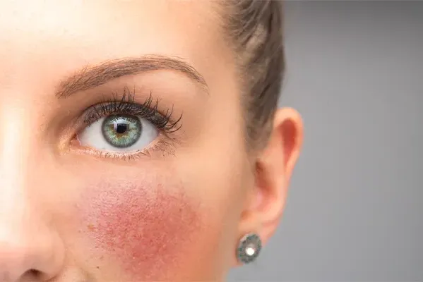 Close-up of a woman with rosacea's face. Schedule treatment for stretch marks from Yashoda Singh, MD in Hamilton-Toronto-Niagara.