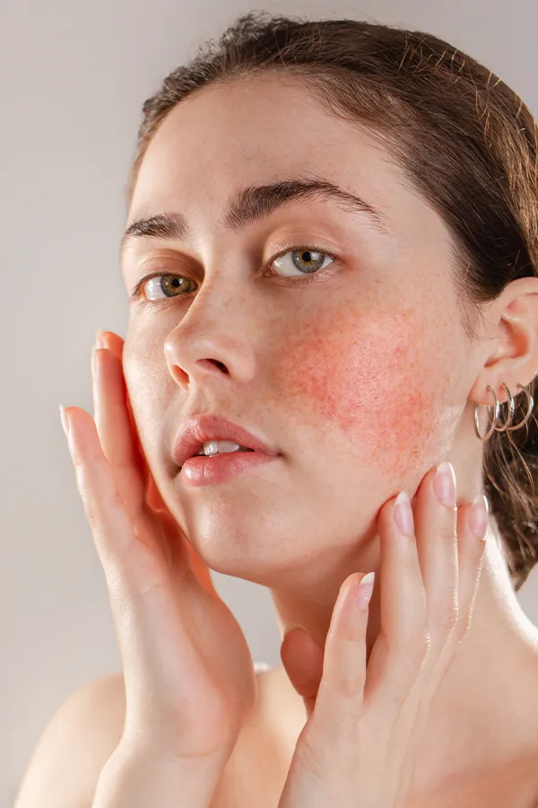 A woman holds her hands around the rosacea on her face. Get rosacea treatment from Yashoda Singh, MD in Hamilton-Toronto-Niagara.