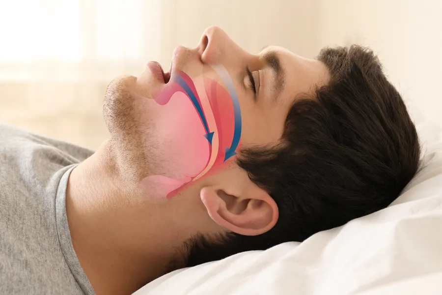 A man sleeping with an illustration of obstructed breathing pathways superimposed. Get sleep apnea and snoring treatment from Yashoda Singh, MD in Hamilton-Toronto-Niagara.