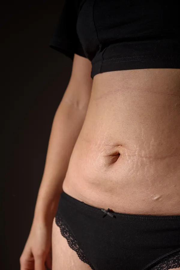 A woman with stretch marks on her belly. Get treatment for stretch marks from Yashoda Singh, MD in Hamilton-Toronto-Niagara.