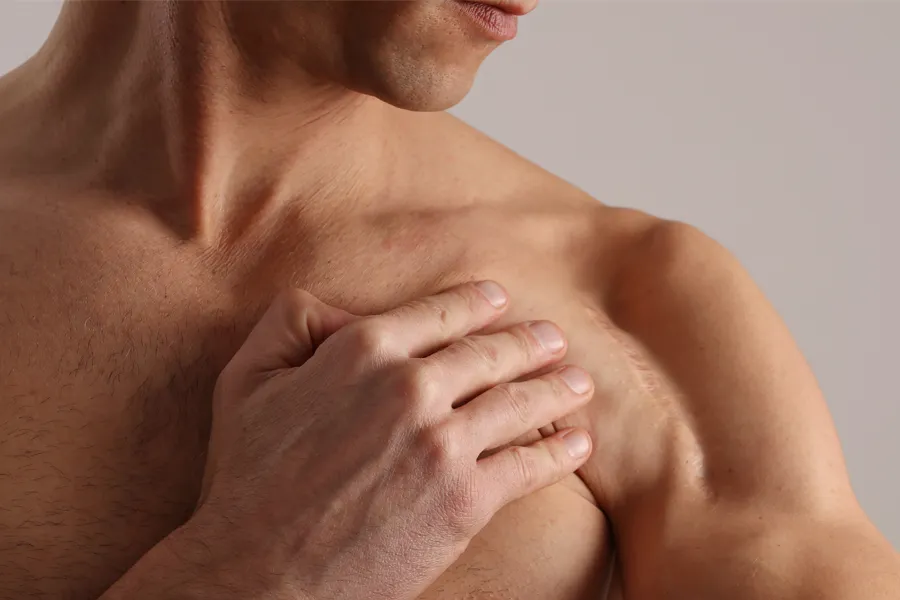 A man with a scar on his shoulder. Get treatment for scars from Yashoda Singh, MD in Hamilton-Toronto-Niagara.