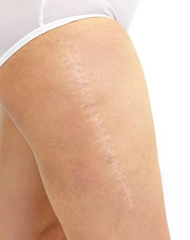 A long scar on a woman's thigh. Get treatment for scars from Yashoda Singh, MD in Hamilton-Toronto-Niagara.