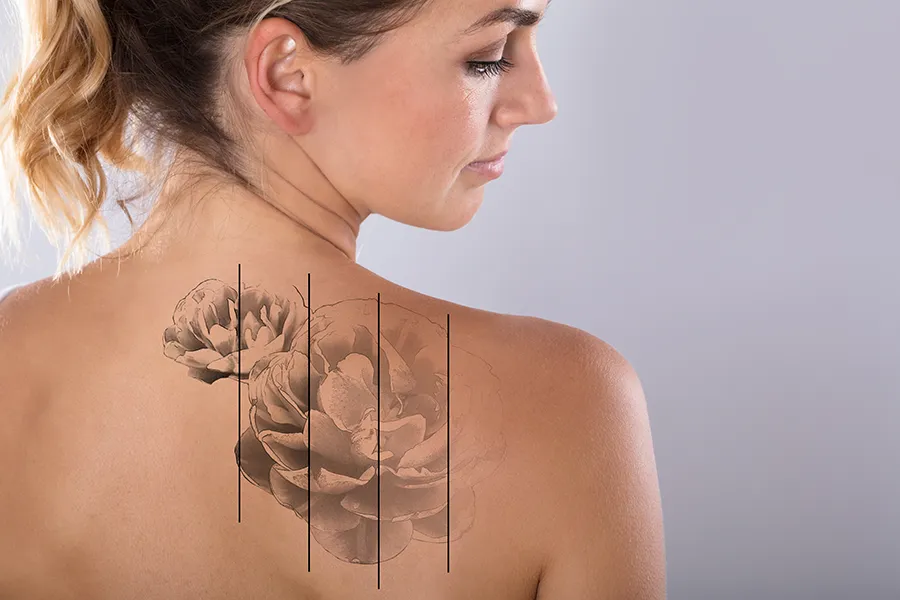 A woman bears her back and shows a tattoo with gradations of the removal process. Get tattoo removal services from Yashoda Singh, MD in Hamilton-Toronto-Niagara.