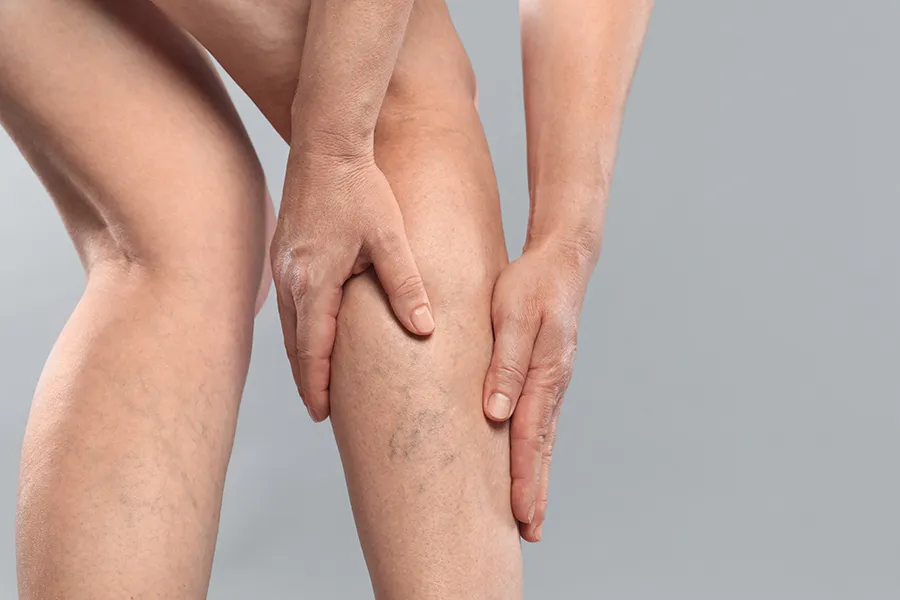 Close-up of a woman putting her hands on the vericose veins on her legs. Get vein and lesion removal treatment from Yashoda Singh, MD in Hamilton-Toronto-Niagara.