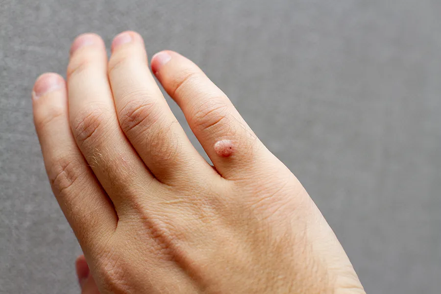 A woman's hand with a wart. Get wart and callus removal from Yashoda Singh, MD in Hamilton-Toronto-Niagara.