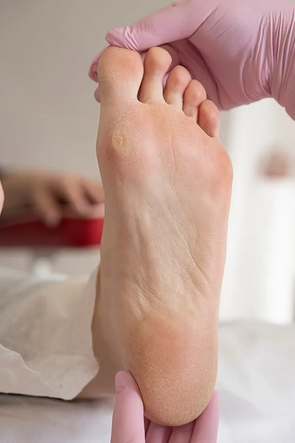 A clinician examines a callus on a man's foot. Get wart and callus removal from Yashoda Singh, MD in Hamilton-Toronto-Niagara.